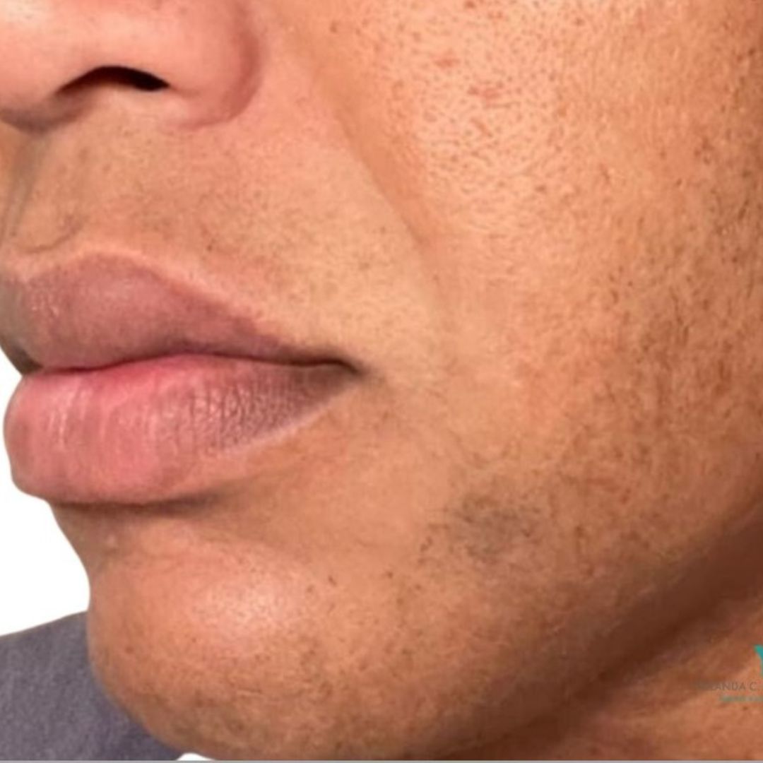 After Laser Hair Removal
