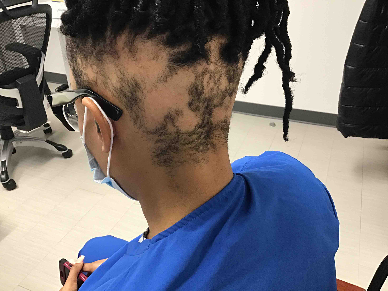 Before Hair Loss
