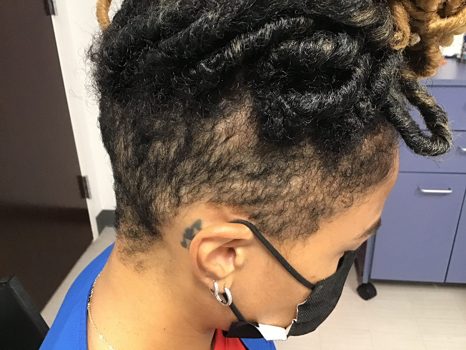 After Hair Loss