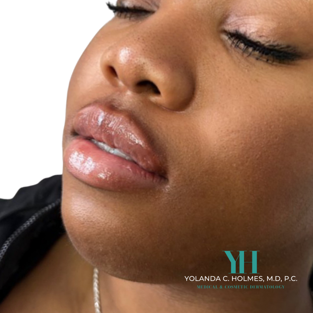After Lip Filler