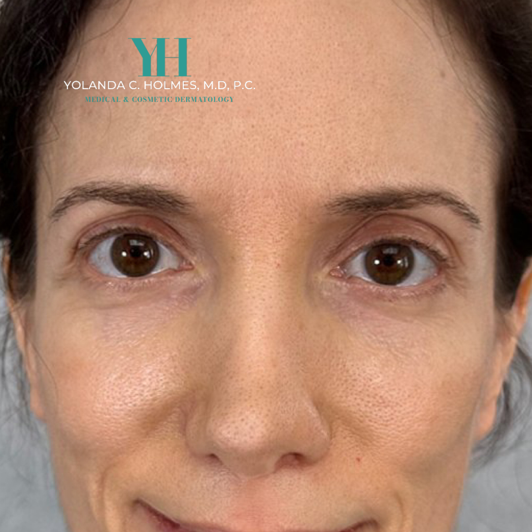 After Under Eye Filler