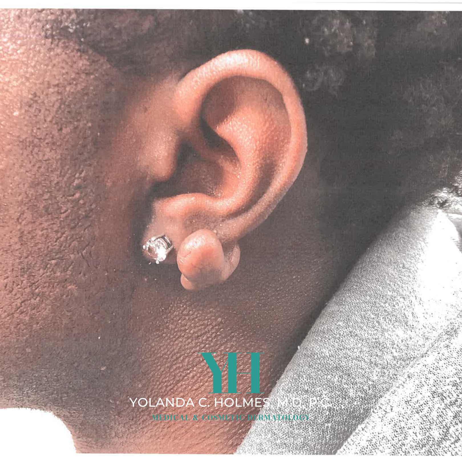 Before Keloid Repair